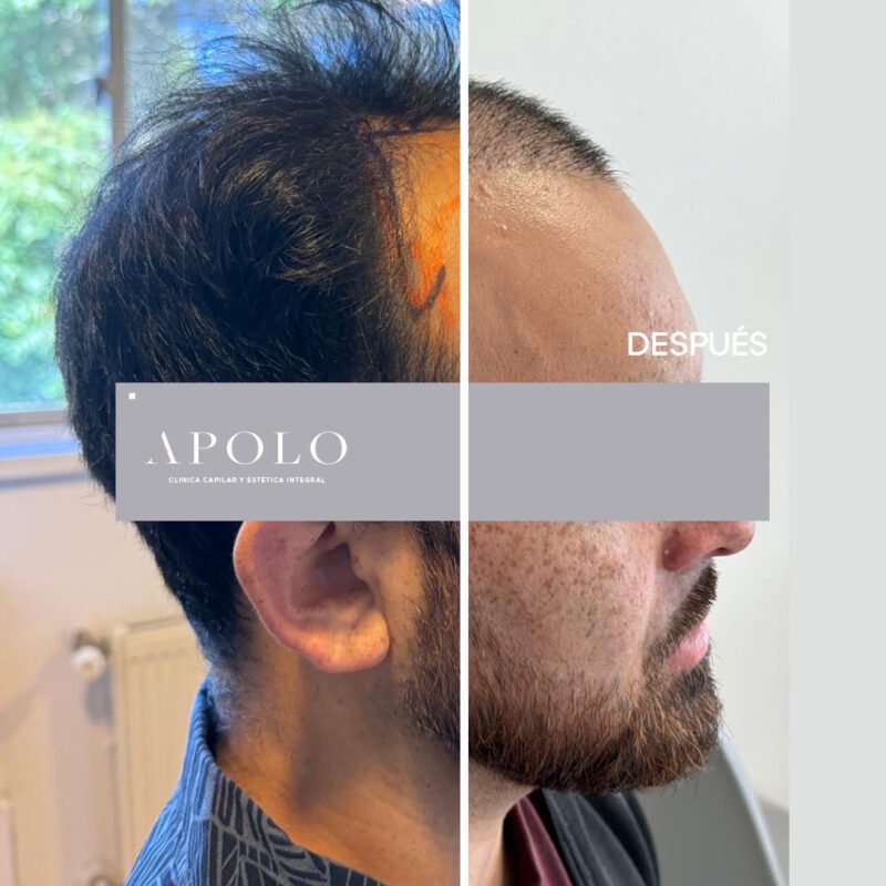 "tratamiento mínimamente invasivo que consiste en la aplicación de microinyecciones en el cuero cabelludo"