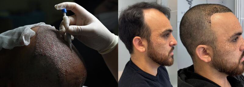 tratamiento con exosomas y células madre es una de las tecnologías más innovadoras en medicina capilar, clínica en Santiago de Chile