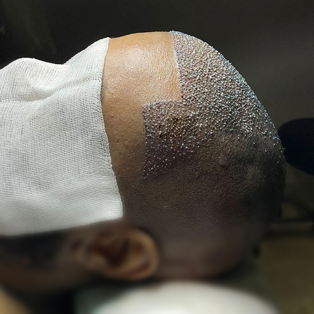 Tratamiento para la caída del cabello en Chile